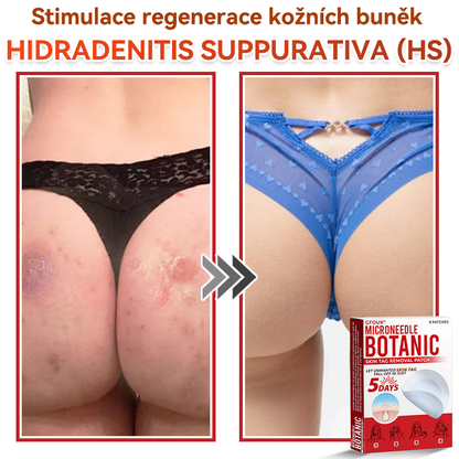🎁 🎁 Zbývá už jen 5 balení! Nyní můžete získat dodatečnou SLEVU 50 %! Pomáhá viditelně zmenšit fibromy, bradavice a další nedokonalosti pokožky — rychle, pohodlně a bez bolesti. 🌿