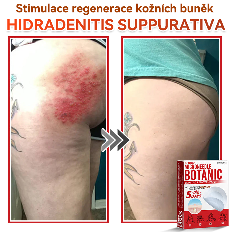 🔥✅GFOUK® Mikrojehličková botanická náplast na odstranění bradavic