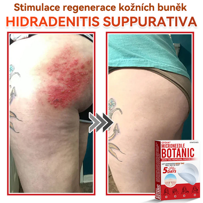 🎁 🎁 Zbývá už jen 5 balení! Nyní můžete získat dodatečnou SLEVU 50 %! Pomáhá viditelně zmenšit fibromy, bradavice a další nedokonalosti pokožky — rychle, pohodlně a bez bolesti. 🌿