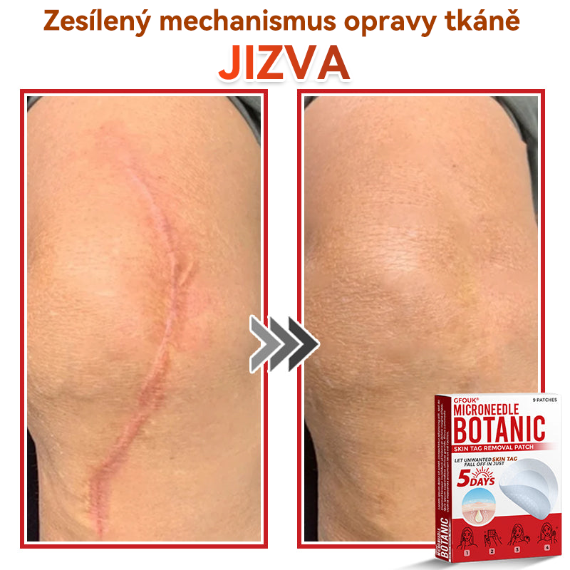 🔥✅GFOUK® Mikrojehličková botanická náplast na odstranění bradavic