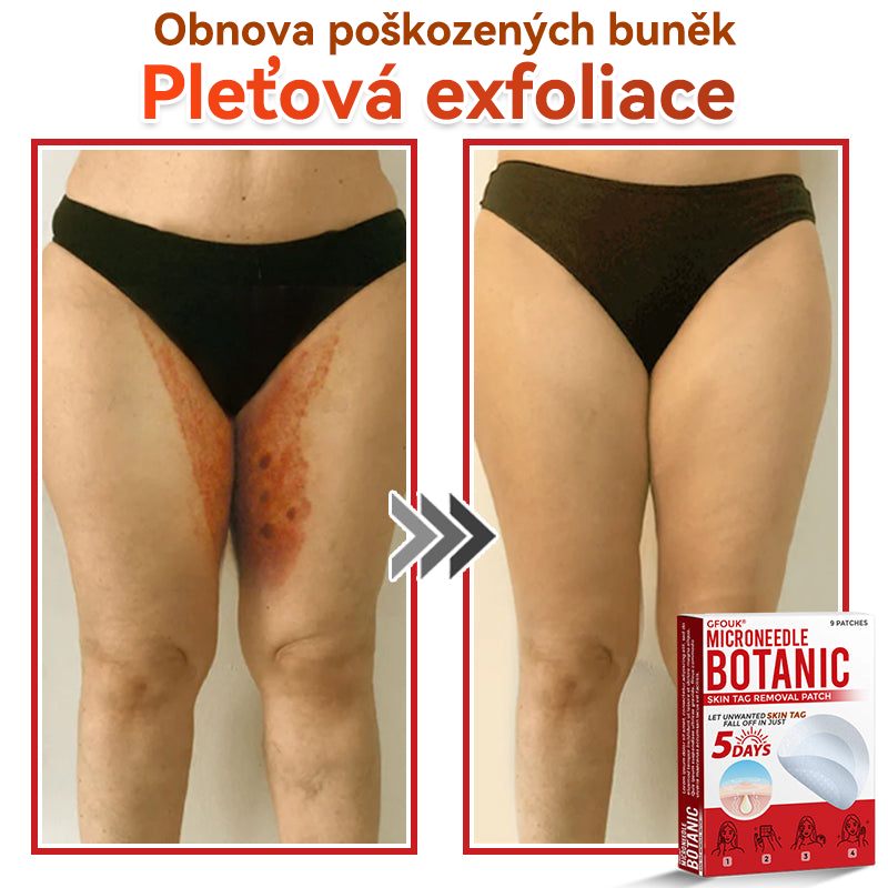 🔥✅GFOUK® Mikrojehličková botanická náplast na odstranění bradavic