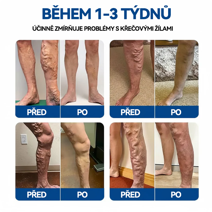 🎁 Zbývá už jen 5 balení! Nyní můžete získat dodatečnou SLEVU 50 %! 🏆🇨🇿👨‍⚕️✅TAILEDEN® VeinEase Mikronáplast s mikrojehličkami⚡Okamžitá úleva, dlouhodobé výsledky