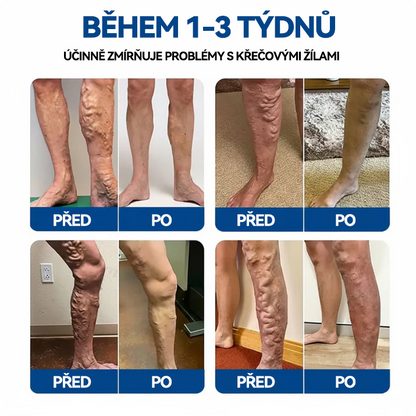 🎁 Zbývá už jen 5 balení! Nyní můžete získat dodatečnou SLEVU 50 %! 🏆🇨🇿👨‍⚕️✅TAILEDEN® VeinEase Mikronáplast s mikrojehličkami⚡Okamžitá úleva, dlouhodobé výsledky