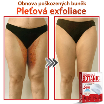 🔥✅GFOUK® Mikrojehličková botanická náplast na odstranění bradavic
