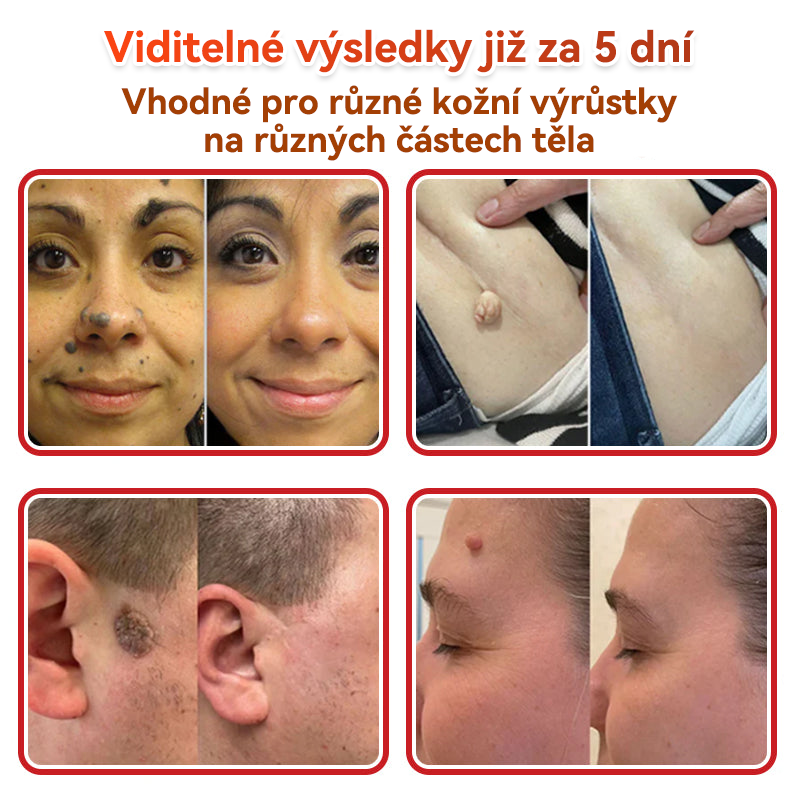 🔥✅GFOUK® Mikrojehličková botanická náplast na odstranění bradavic
