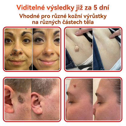 🔥✅GFOUK® Mikrojehličková botanická náplast na odstranění bradavic