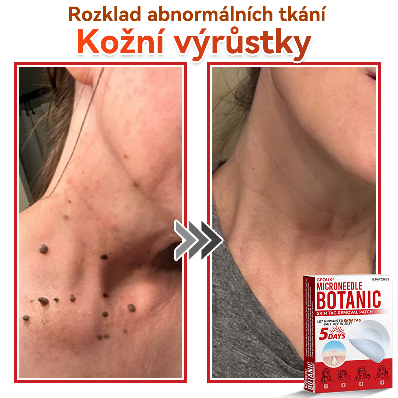 🎁 🎁 Zbývá už jen 5 balení! Nyní můžete získat dodatečnou SLEVU 50 %! Pomáhá viditelně zmenšit fibromy, bradavice a další nedokonalosti pokožky — rychle, pohodlně a bez bolesti. 🌿