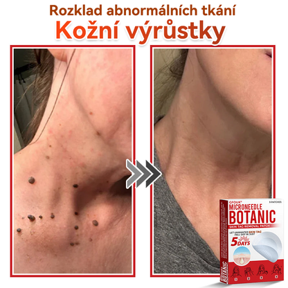 🔥✅GFOUK® Mikrojehličková botanická náplast na odstranění bradavic