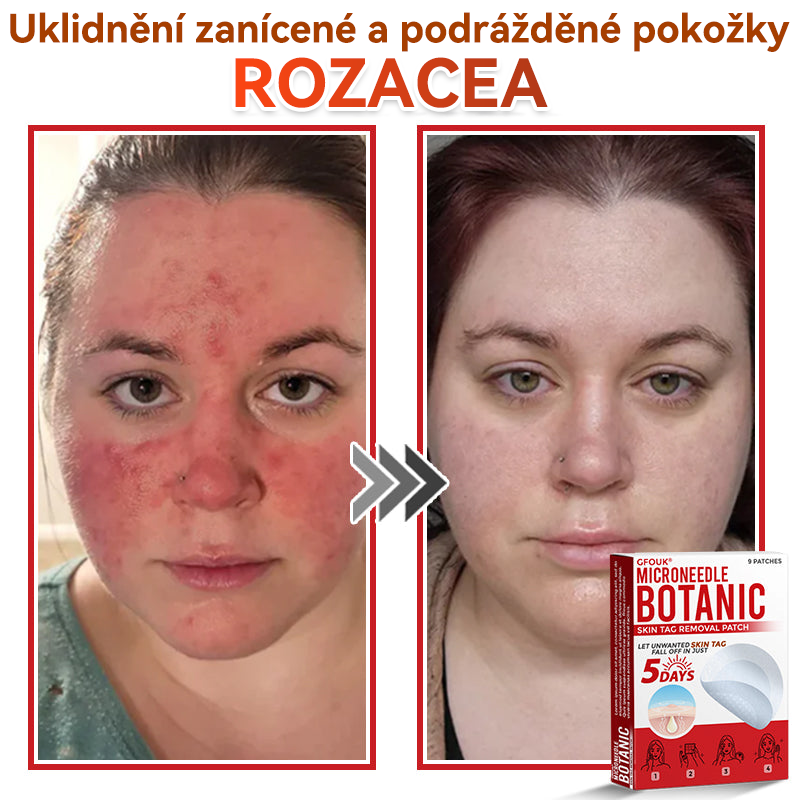 🎁 🎁 Zbývá už jen 5 balení! Nyní můžete získat dodatečnou SLEVU 50 %! Pomáhá viditelně zmenšit fibromy, bradavice a další nedokonalosti pokožky — rychle, pohodlně a bez bolesti. 🌿