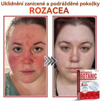🎁 🎁 Zbývá už jen 5 balení! Nyní můžete získat dodatečnou SLEVU 50 %! Pomáhá viditelně zmenšit fibromy, bradavice a další nedokonalosti pokožky — rychle, pohodlně a bez bolesti. 🌿