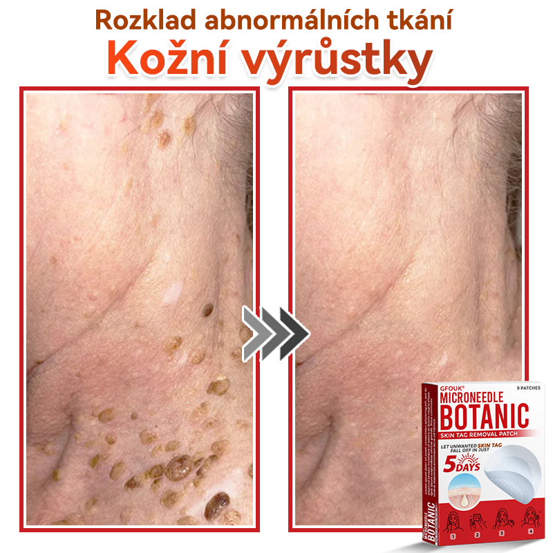 🎁 🎁 Zbývá už jen 5 balení! Nyní můžete získat dodatečnou SLEVU 50 %! Pomáhá viditelně zmenšit fibromy, bradavice a další nedokonalosti pokožky — rychle, pohodlně a bez bolesti. 🌿