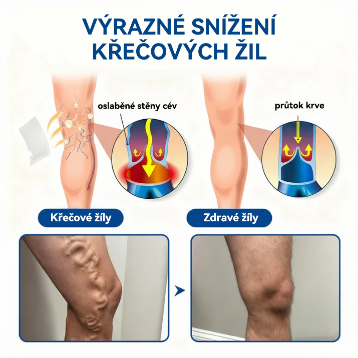 🎁 Zbývá už jen 5 balení! Nyní můžete získat dodatečnou SLEVU 50 %! 🏆🇨🇿👨‍⚕️✅TAILEDEN® VeinEase Mikronáplast s mikrojehličkami⚡Okamžitá úleva, dlouhodobé výsledky