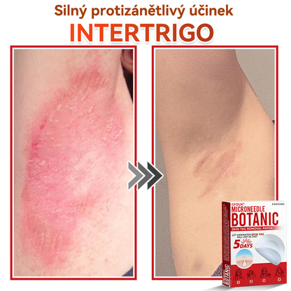 🔥✅GFOUK® Mikrojehličková botanická náplast na odstranění bradavic